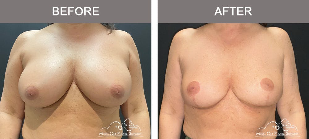 Breast Reduction Before & After Gallery - Patient 144581 - Image 1