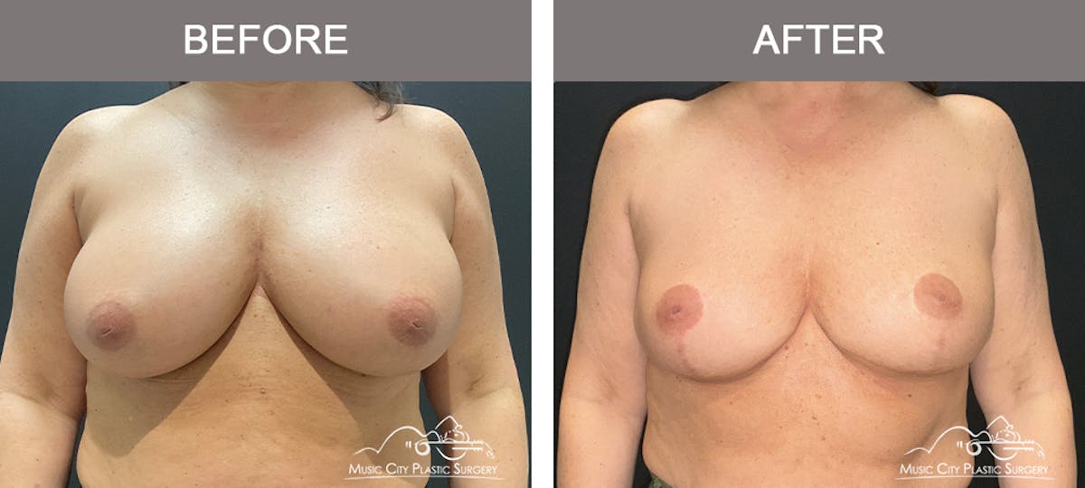 Breast Reduction Before & After Gallery - Patient 144581 - Image 1