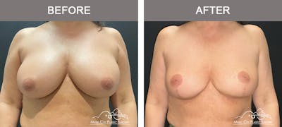 Breast Reduction Before & After Gallery - Patient 144581 - Image 1