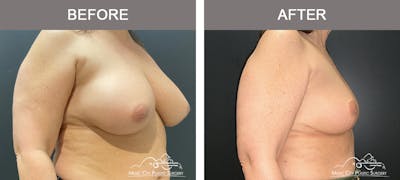 Breast Reduction Before & After Gallery - Patient 144581 - Image 2