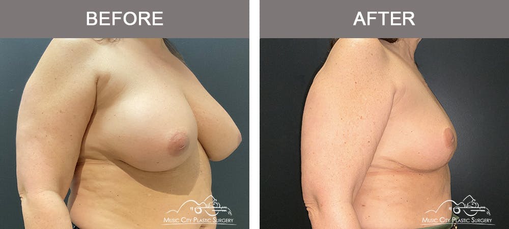 Breast Reduction Before & After Gallery - Patient 144581 - Image 2