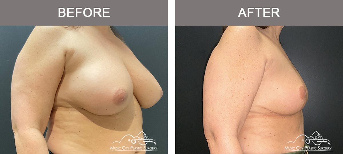 Breast Reduction Before & After Gallery - Patient 144581 - Image 2