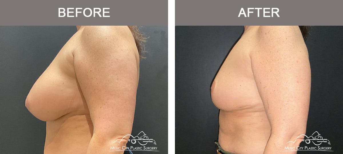 Breast Reduction Before & After Gallery - Patient 144581 - Image 3