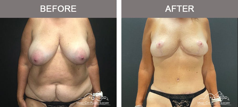 Mommy Makeover Before & After Gallery - Patient 182694 - Image 1