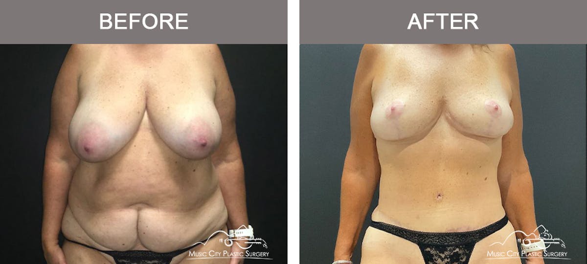 Mommy Makeover Before & After Gallery - Patient 182694 - Image 1