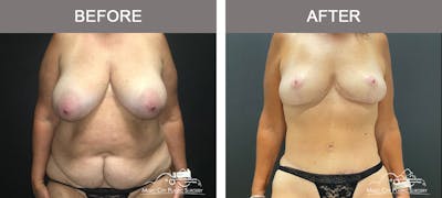 Mommy Makeover Before & After Gallery - Patient 182694 - Image 1