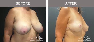 Breast Reduction Before & After Gallery - Patient 506320 - Image 2