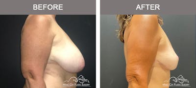 Breast Reduction Before & After Gallery - Patient 506320 - Image 3