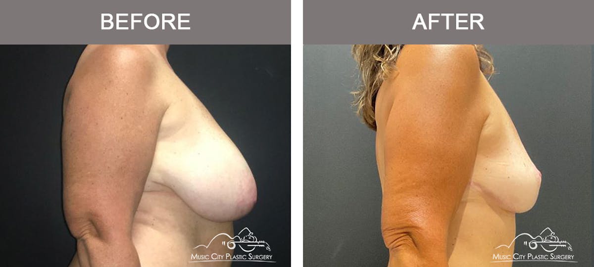Breast Reduction Before & After Gallery - Patient 506320 - Image 3