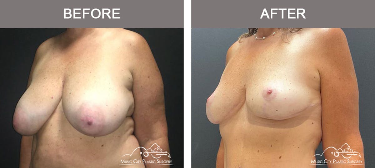 Breast Reduction Before & After Gallery - Patient 506320 - Image 4