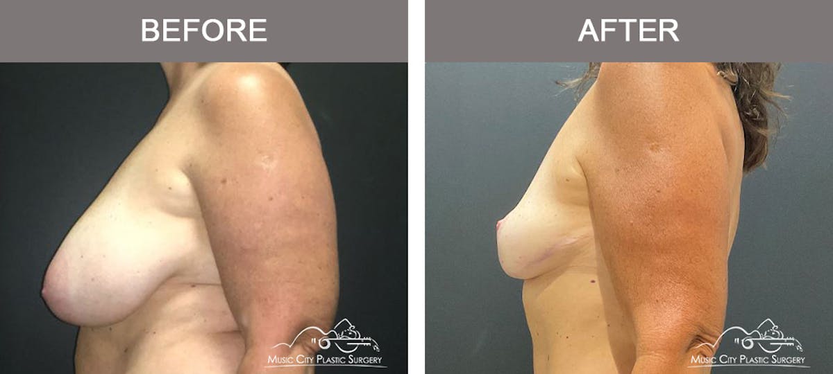 Breast Reduction Before & After Gallery - Patient 506320 - Image 5