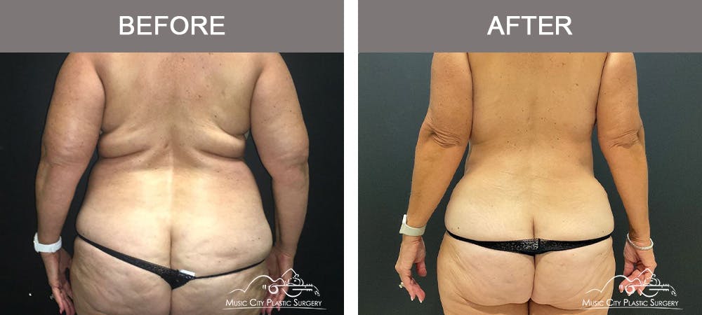 Mommy Makeover Before & After Gallery - Patient 182694 - Image 6