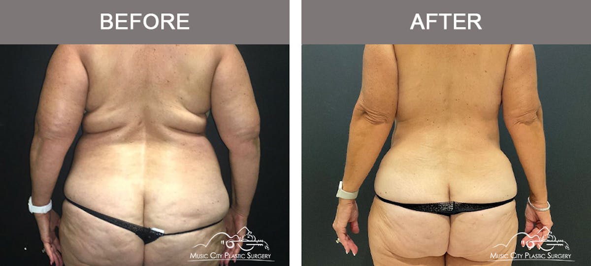 Mommy Makeover Before & After Gallery - Patient 182694 - Image 6