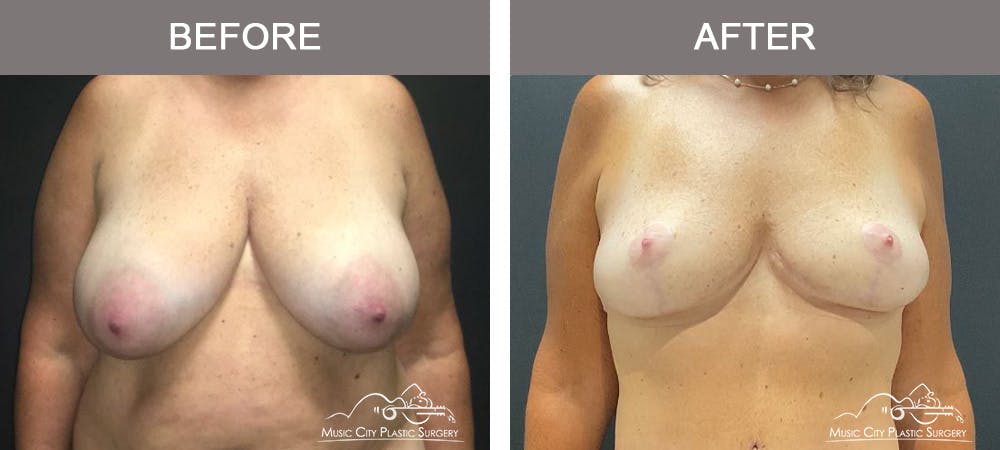 Breast Reduction Before & After Gallery - Patient 506320 - Image 1