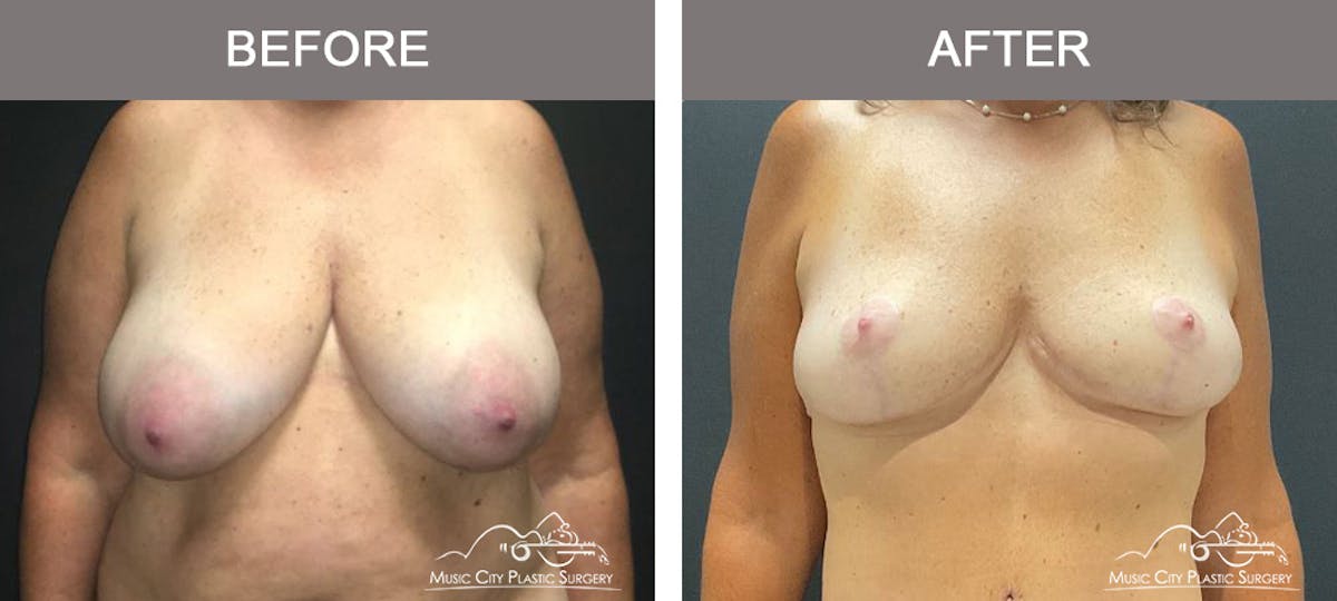 Breast Reduction Before & After Gallery - Patient 506320 - Image 1