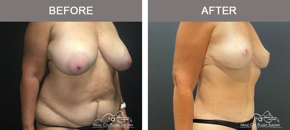 Mommy Makeover Before & After Gallery - Patient 182694 - Image 2