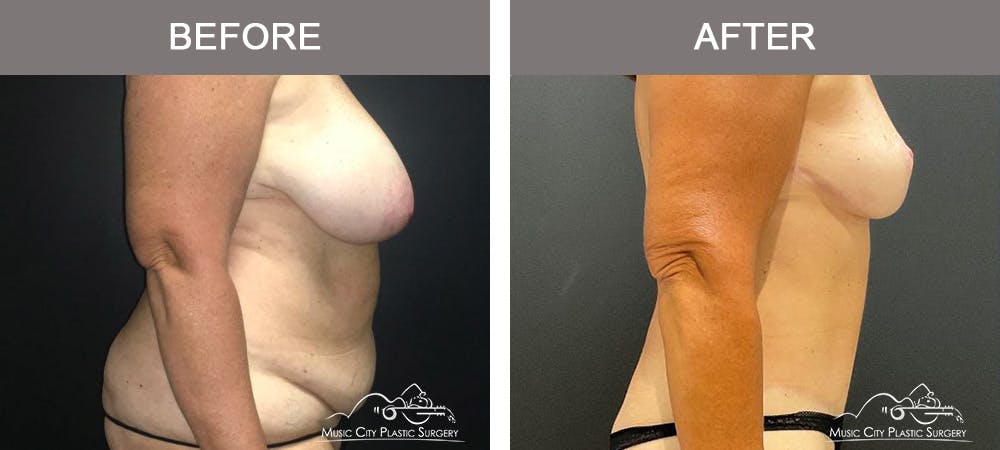 Mommy Makeover Before & After Gallery - Patient 182694 - Image 3
