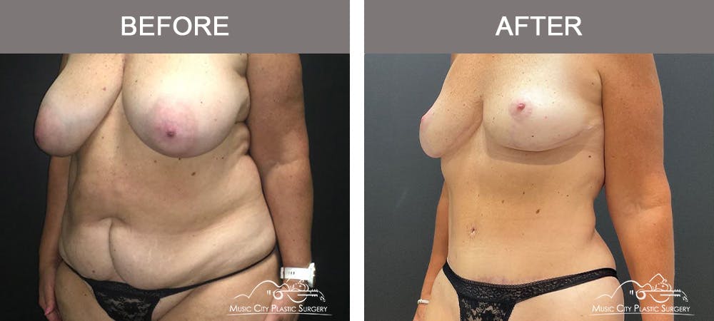 Mommy Makeover Before & After Gallery - Patient 182694 - Image 4