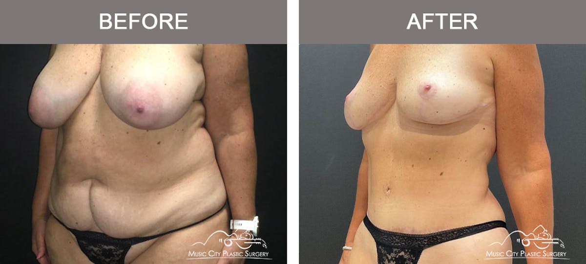 Mommy Makeover Before & After Gallery - Patient 182694 - Image 4