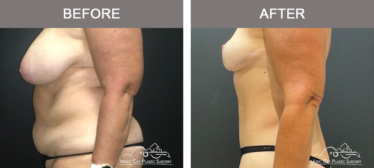 Mommy Makeover Before & After Gallery - Patient 182694 - Image 5