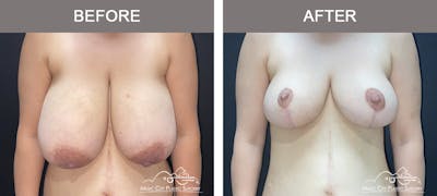 Breast Reduction Before & After Gallery - Patient 586638 - Image 1