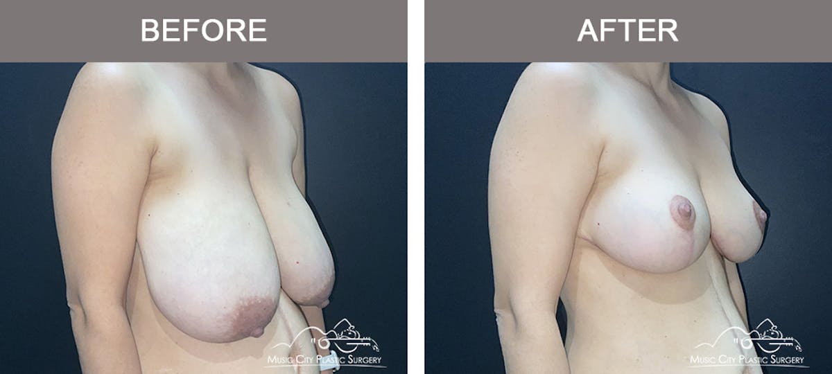 Breast Lift Before & After Gallery - Patient 175098 - Image 2