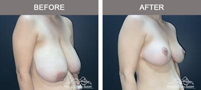Breast Reduction Before & After Gallery - Patient 586638 - Image 2