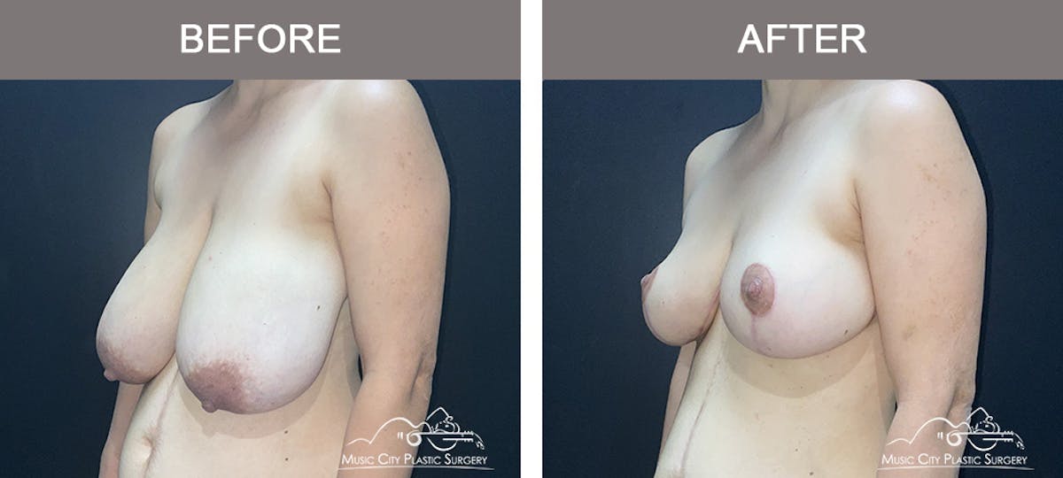 Breast Lift Before & After Gallery - Patient 175098 - Image 3