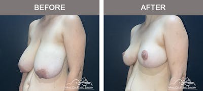 Breast Reduction Before & After Gallery - Patient 586638 - Image 3