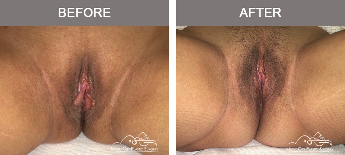 Labiaplasty Before & After Gallery - Patient 90704963 - Image 1