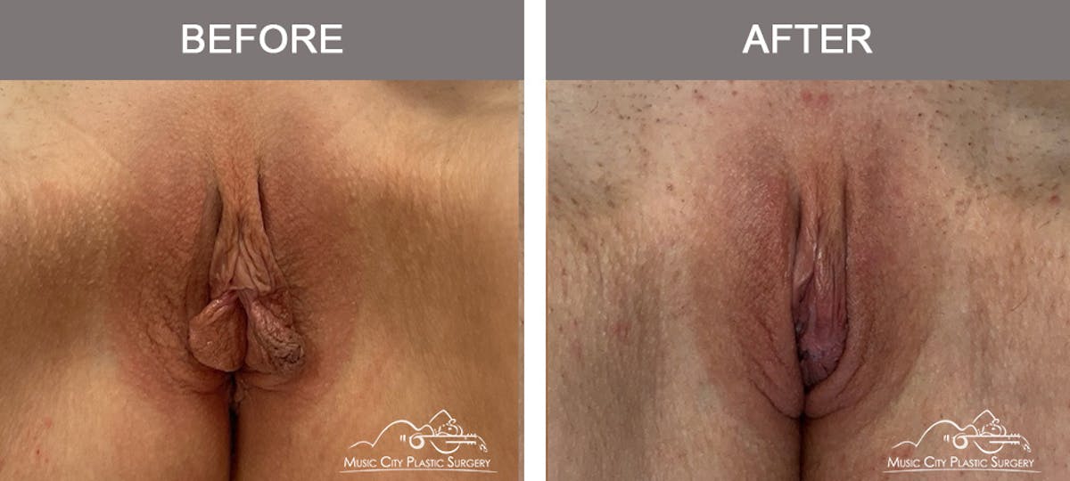 Labiaplasty Before & After Gallery - Patient 421210 - Image 1