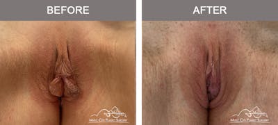 Labiaplasty Before & After Gallery - Patient 421210 - Image 1