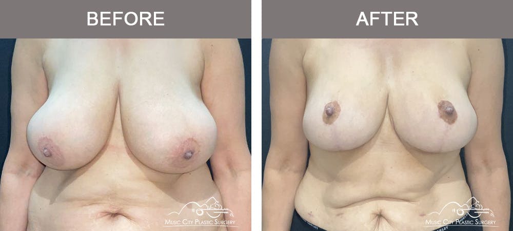 Breast Reduction with Lift Before & After Gallery - Patient 194968 - Image 1