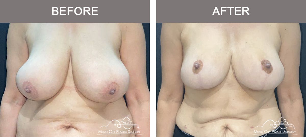 Breast Reduction with Lift Before & After Gallery - Patient 194968 - Image 1