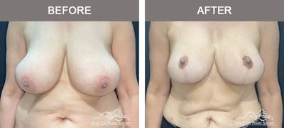 Breast Reduction with Lift Before & After Gallery - Patient 194968 - Image 1