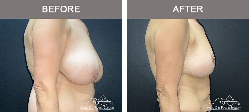 Breast Reduction with Lift Before & After Gallery - Patient 194968 - Image 2