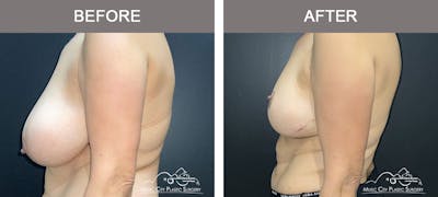 Breast Lift Before & After Gallery - Patient 788313 - Image 3
