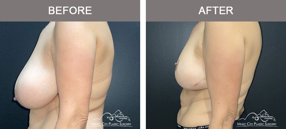 Breast Reduction with Lift Before & After Gallery - Patient 194968 - Image 3