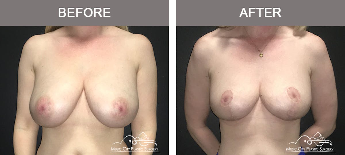 Breast Lift Before & After Gallery - Patient 138200 - Image 1