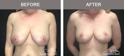 Breast Reduction with Lift Before & After Gallery - Patient 150267 - Image 1