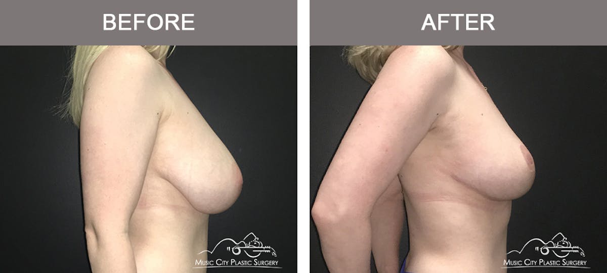 Breast Lift Before & After Gallery - Patient 138200 - Image 2