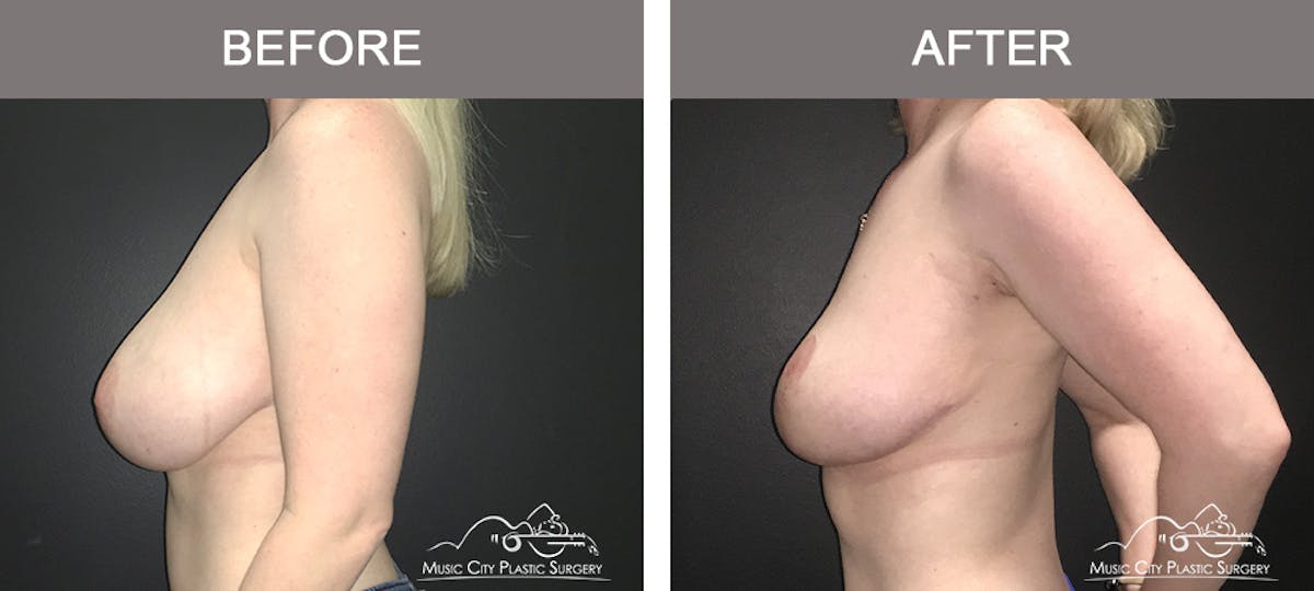 Breast Lift Before & After Gallery - Patient 138200 - Image 3