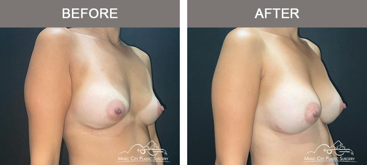 Implant Exchange Before & After Gallery - Patient 164684 - Image 1