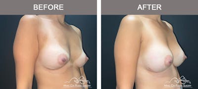 Implant Exchange Before & After Gallery - Patient 164684 - Image 1