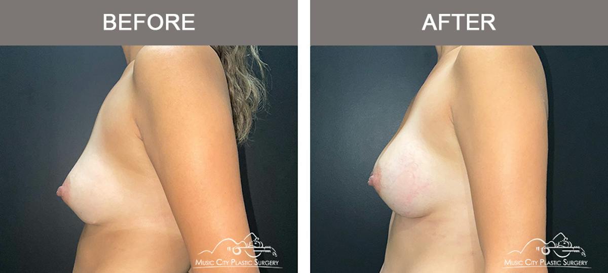 Implant Exchange Before & After Gallery - Patient 164684 - Image 2