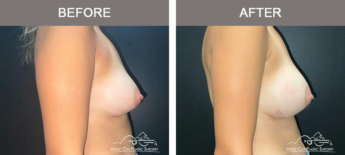 Implant Exchange Before & After Gallery - Patient 164684 - Image 3
