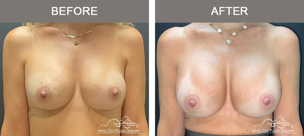 Implant Exchange Before & After Gallery - Patient 518854 - Image 1