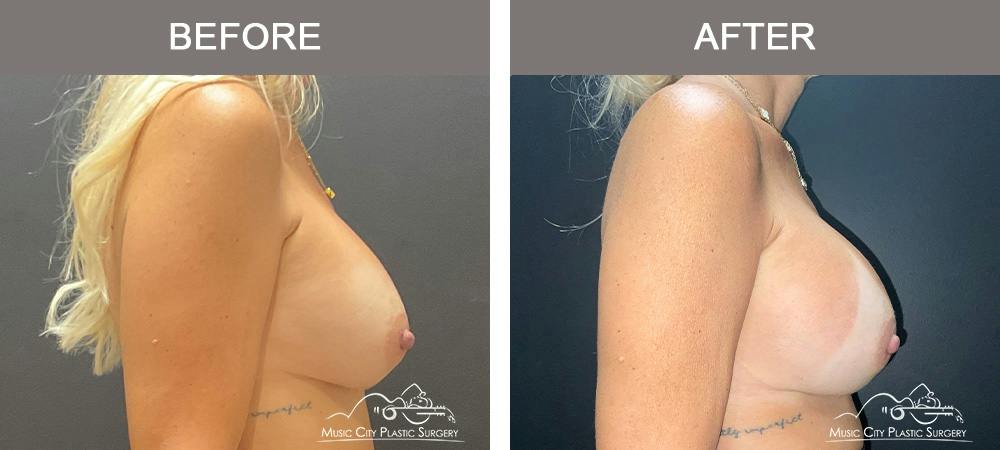 Implant Exchange Before & After Gallery - Patient 518854 - Image 3