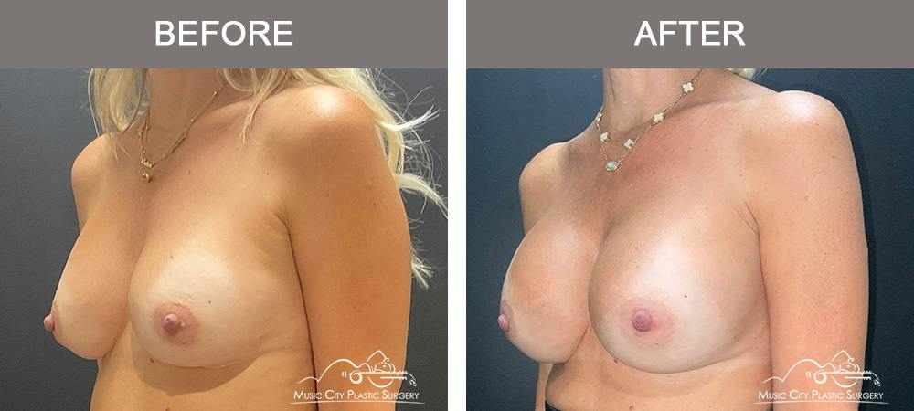 Implant Exchange Before & After Gallery - Patient 518854 - Image 5