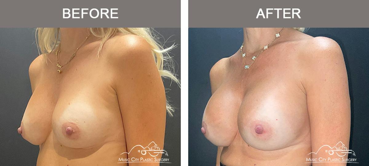 Implant Exchange Before & After Gallery - Patient 518854 - Image 5